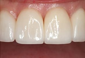 Winchester Dental | Ceramic Crowns, Dental Bonding and ZOOM Whitening