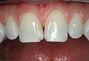 Winchester Dental | Root Canals, Dental Bonding and Veneers